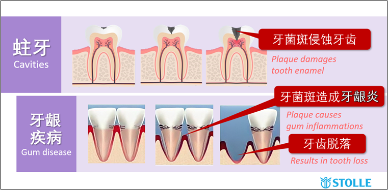 Plaque is the cause of dental problems